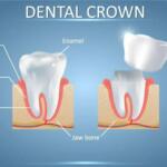 Tooth Crown - A Comprehensive Guide On Dental Crowns