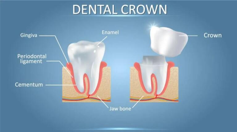 Tooth Crown - A Comprehensive Guide On Dental Crowns