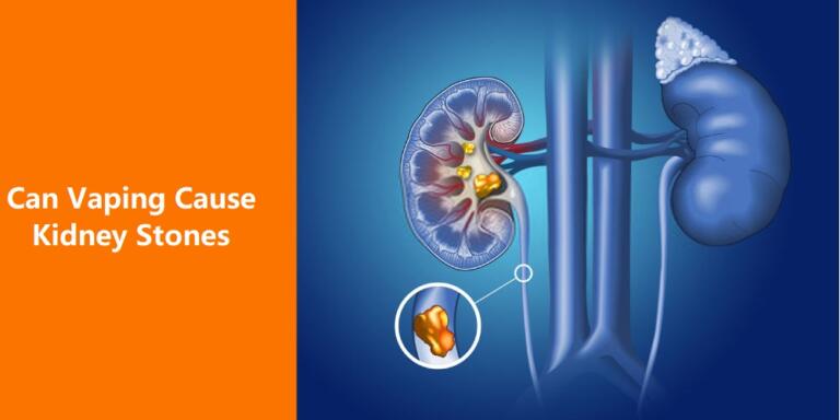 Can Vaping Cause Kidney Stones