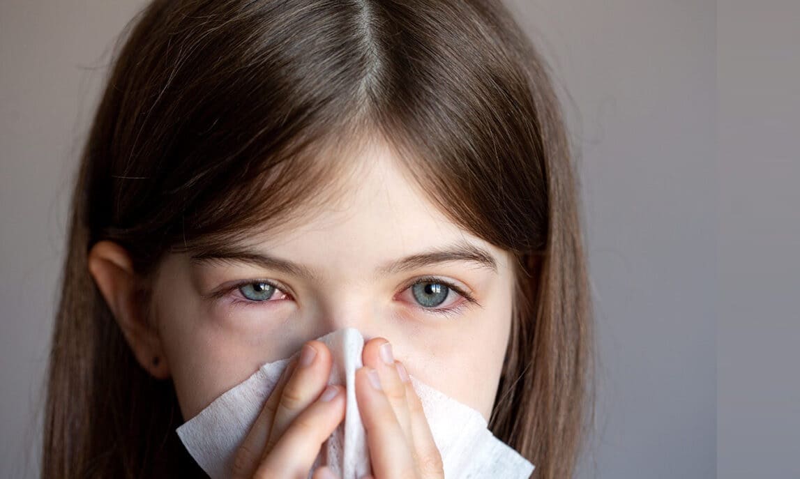 Allergic Conjunctivitis A Complete Overview with Treatment