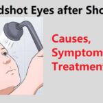 Bloodshot Eyes after Shower