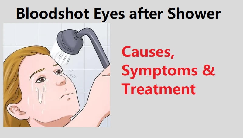 Bloodshot Eyes after Shower