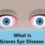 Graves Eye Disease
