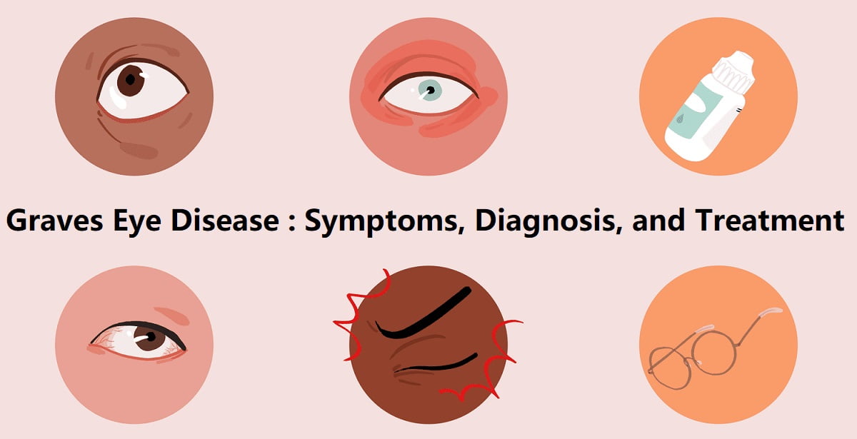 Graves Eye Disease Symptoms Diagnosis And Treatment 2025 Quick Medico