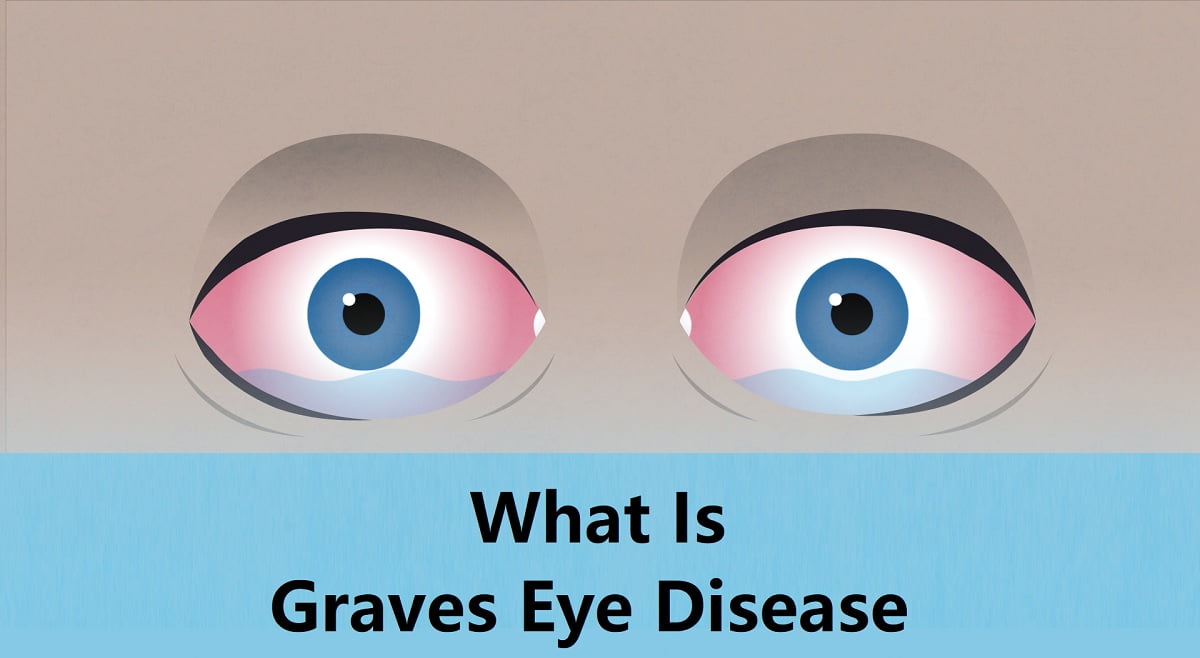 Graves Eye Disease