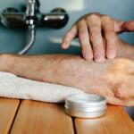 How to Reduce Hard Water Psoriasis