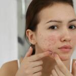 Main Types of Acne Scars and How to Treat Them All