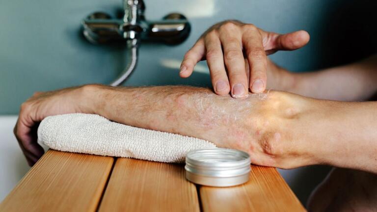 Skin Peeling after Shower