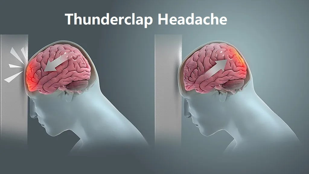 Thunderclap Headache