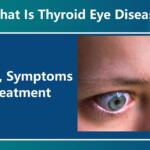 Thyroid Eye Disease : Causes, Symptoms, and Treatment