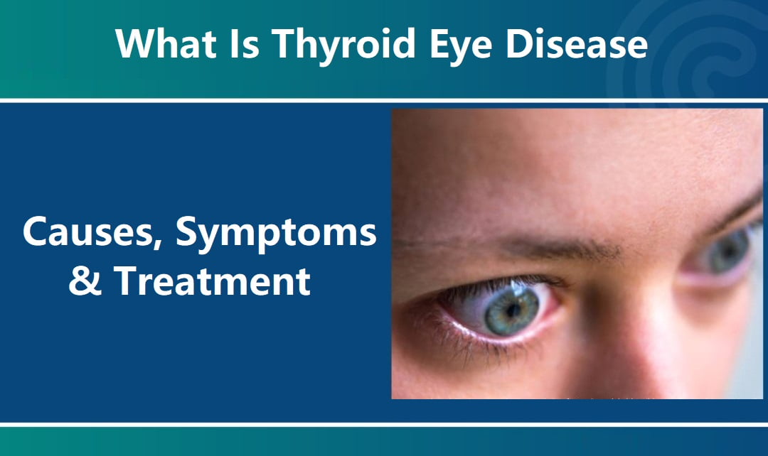 Thyroid Eye Disease : Causes, Symptoms, and Treatment