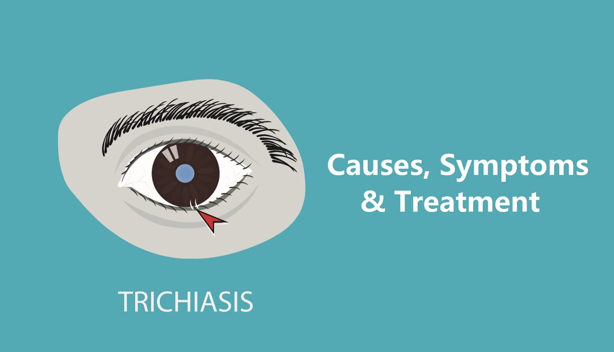 Trichiasis (Ingrown Eyelash): Causes, Symptoms, & Treatment