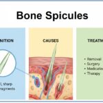 Bone Spicules - Definition, Causes, & Treatment