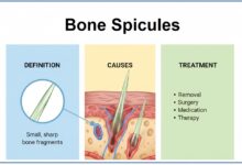 Bone Spicules - Definition, Causes, & Treatment