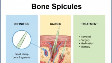 Bone Spicules - Definition, Causes, & Treatment
