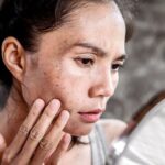 How to Remove Age Spots