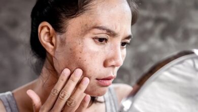 How to Remove Age Spots