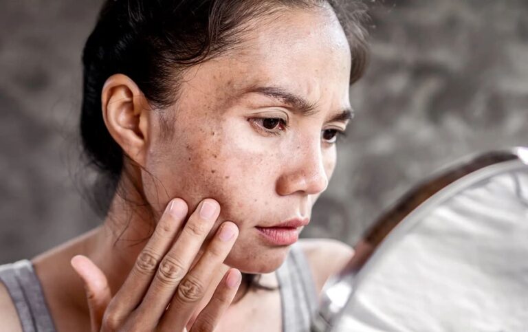 How to Remove Age Spots